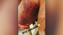 Травмированная нога Александра ОВЕЧКИНА.