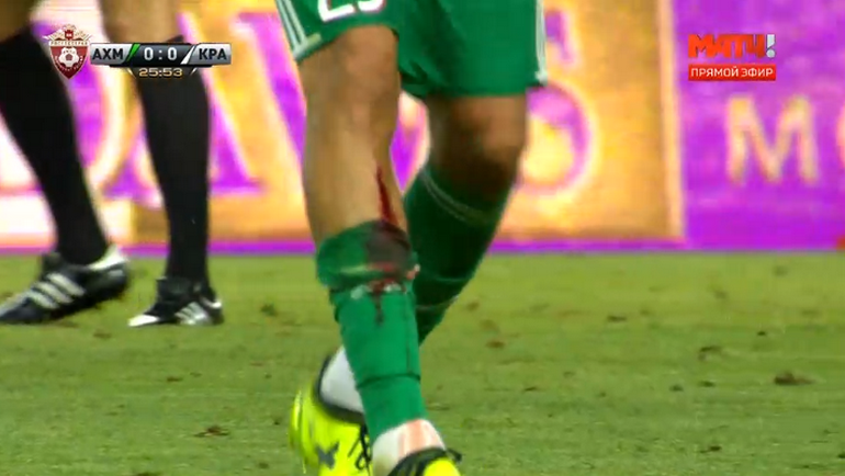 Травма Антона Швеца. Травма Антона Швеца.