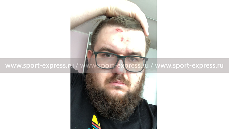 Ссадины на лице Андрея ИЗМАЙЛОВА. Ссадины на лице Андрея ИЗМАЙЛОВА.