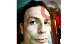 Игорь РАБИНЕР после нападения Сергея Кирьякова.