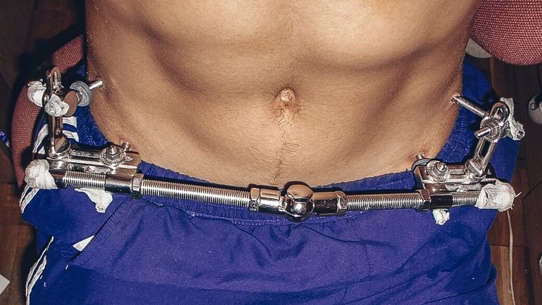 Стержневой аппарат, с которым Илье Трифанову пришлось провести два месяца. Фото Личный архив Ильи Трифанова Стержневой аппарат, с которым Илье Трифанову пришлось провести два месяца. Фото Личный архив Ильи Трифанова