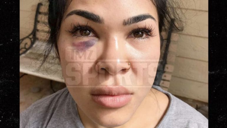 Рэйчел Остович после избиения мужем. Фото Твиттер Рэйчел Остович после избиения мужем. Фото Твиттер