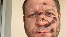 Александр Емельяненко после падения с велосипеда.