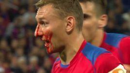 Федор Чалов после удара по лицу.