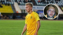 Помните парня из «Луча» с жутким переломом челюсти? Он хочет вернуться на поле уже в ноябре