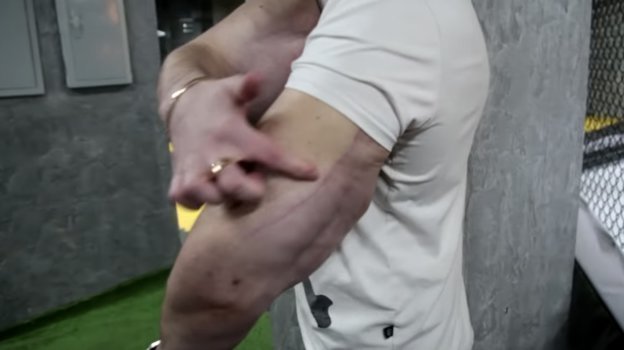 Руки Терешина после операции. Фото Youtube-канал Body Mania Руки Терешина после операции. Фото Youtube-канал Body Mania