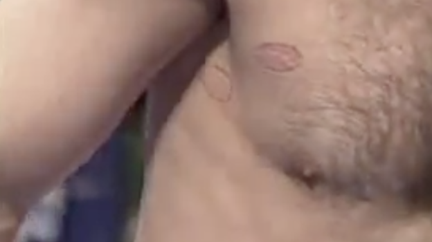 23 мая 1998 года. Следы от укуса Гилберта Айвела на груди Каримулы Баркалаева. 23 мая 1998 года. Следы от укуса Гилберта Айвела на груди Каримулы Баркалаева.