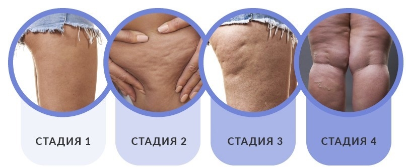 Стадии целлюлита. Стадии целлюлита.