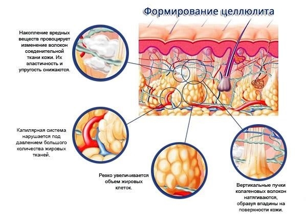 Формирование целлюлита. Формирование целлюлита.