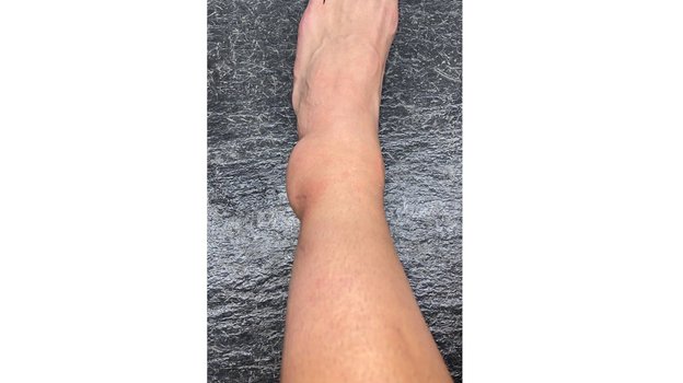 Нога Себальоса после травмы, полученной в матче с Египтом. Фото Twitter Нога Себальоса после травмы, полученной в матче с Египтом. Фото Twitter