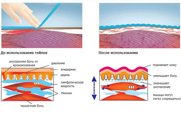 Как работают кинезиотейпы. Как работают кинезиотейпы.