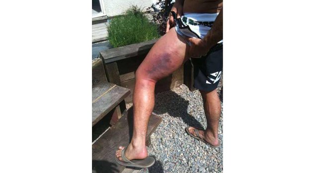 Нога Юрайи Фабера после боя с Жозе Альдо в апреле 2010-го. Бразилец в том поединке нанес 27 точных лоукиков. Нога Юрайи Фабера после боя с Жозе Альдо в апреле 2010-го. Бразилец в том поединке нанес 27 точных лоукиков.