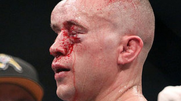 Марку Хоминику разрешили продолжить бой с Жозе Альдо, несмотря на гигантскую гематому. Марку Хоминику разрешили продолжить бой с Жозе Альдо, несмотря на гигантскую гематому.