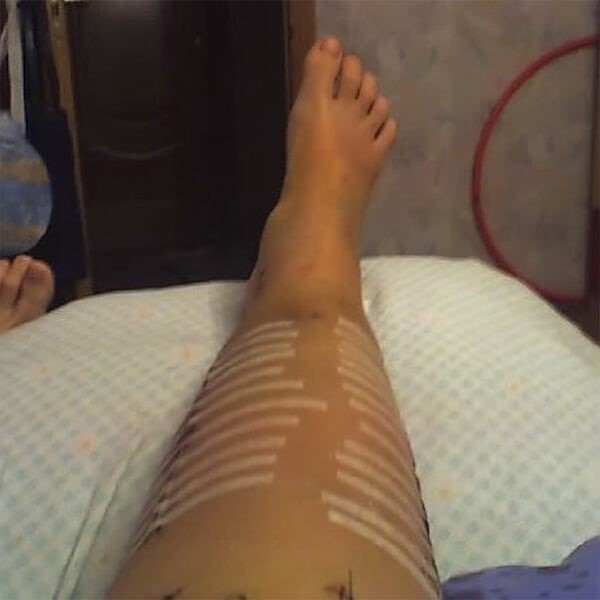 Нога Марии Комиссаровой после операции. Фото sports.ru Нога Марии Комиссаровой после операции. Фото sports.ru