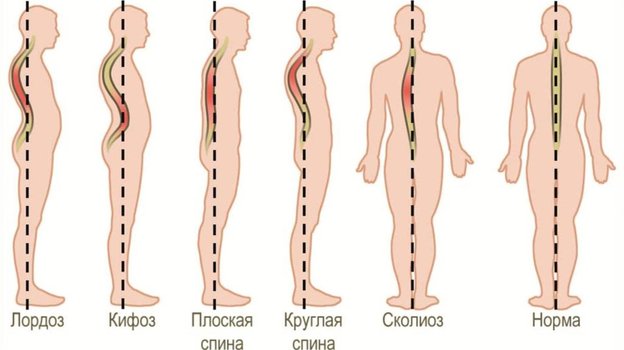 Нарушение осанки. Фото Spina Expert Нарушение осанки. Фото Spina Expert