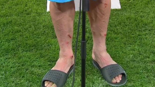 Ноги Эктора Эрреры после ответной игры Лиги чемпионов с «МЮ» (1:0). Ноги Эктора Эрреры после ответной игры Лиги чемпионов с «МЮ» (1:0).