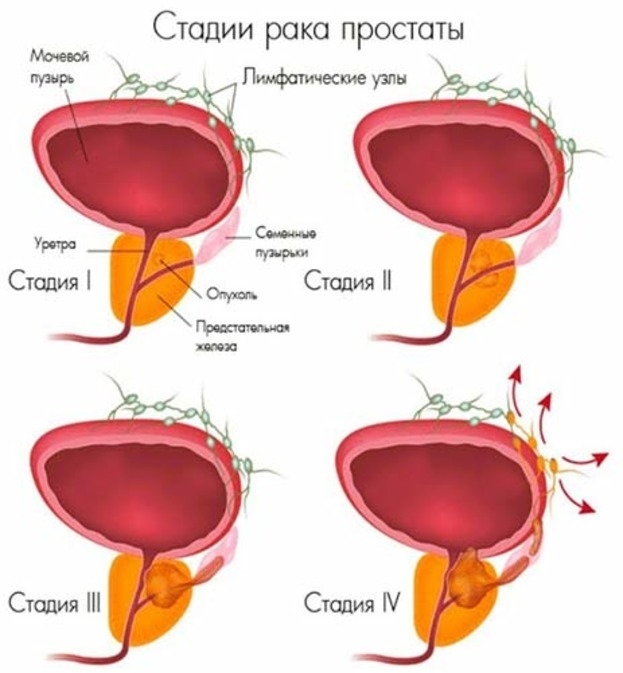 Стадии рака простаты. Фото euroonco.ru Стадии рака простаты. Фото euroonco.ru