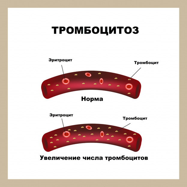 Тромбоциты. Фото invitro.ru Тромбоциты. Фото invitro.ru