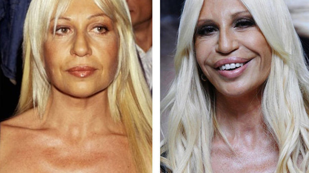 Донателла Версаче до и после пластических операций. Донателла Версаче до и после пластических операций.