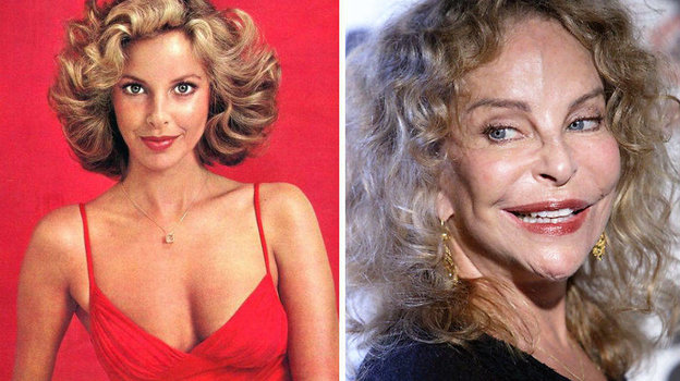 Сидни Ром до и после пластики. Сидни Ром до и после пластики.