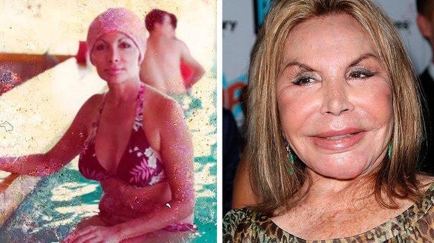 Эльза Паттон до и после вмешательства пластического хирурга. Эльза Паттон до и после вмешательства пластического хирурга.