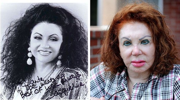 Жаклин Сталлоне до и после пластической хирургии. Жаклин Сталлоне до и после пластической хирургии.