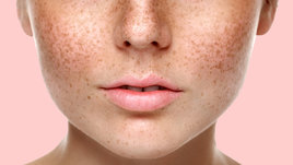 Пигментные пятна, как с ними бороться? Мнение эксперта