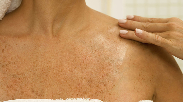 Пигментные пятна. Пигментные пятна.