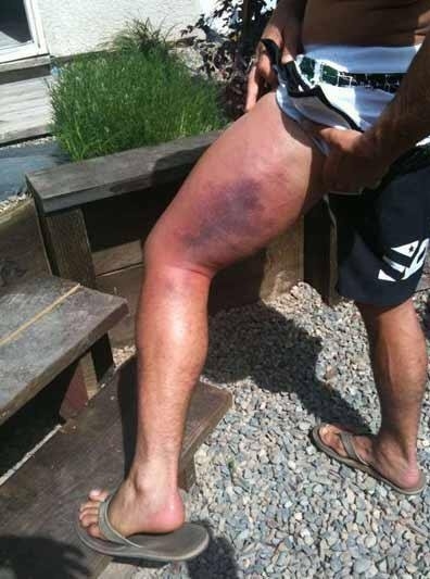 Нога Фейбера после лоукиков Альдо. Фото Соцсети Нога Фейбера после лоукиков Альдо. Фото Соцсети