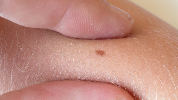 Родинка. Фото Global Look Press Родинка. Фото Global Look Press