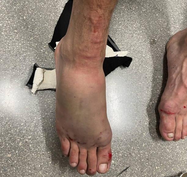 Стопа Родригеса после боя с Холлоуэем. Фото Соцсети Стопа Родригеса после боя с Холлоуэем. Фото Соцсети