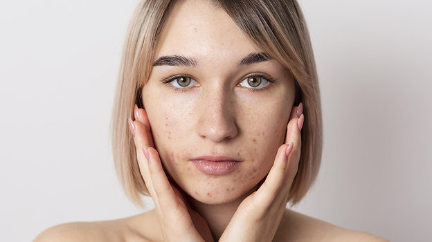 Акне. Фото Freepik Акне. Фото Freepik