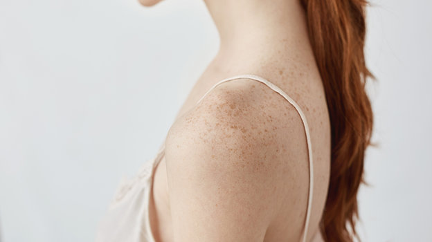 Пигментные пятна. Фото Freepik/cookie_studio Пигментные пятна. Фото Freepik/cookie_studio