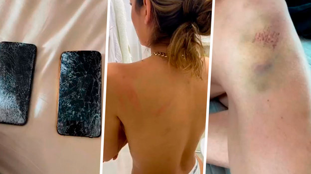 Следы избиений Веллитона на теле бывшей жены. Фото из соцсетей Рафаэлы Карвальо Следы избиений Веллитона на теле бывшей жены. Фото из соцсетей Рафаэлы Карвальо