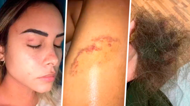 Следы избиений Веллитона на теле бывшей жены. Фото из соцсетей Рафаэлы Карвальо Следы избиений Веллитона на теле бывшей жены. Фото из соцсетей Рафаэлы Карвальо