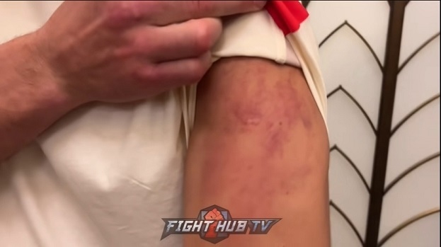 Рука Бивола после ударов Канело. Рука Дмитрия Бивола после ударов Канело