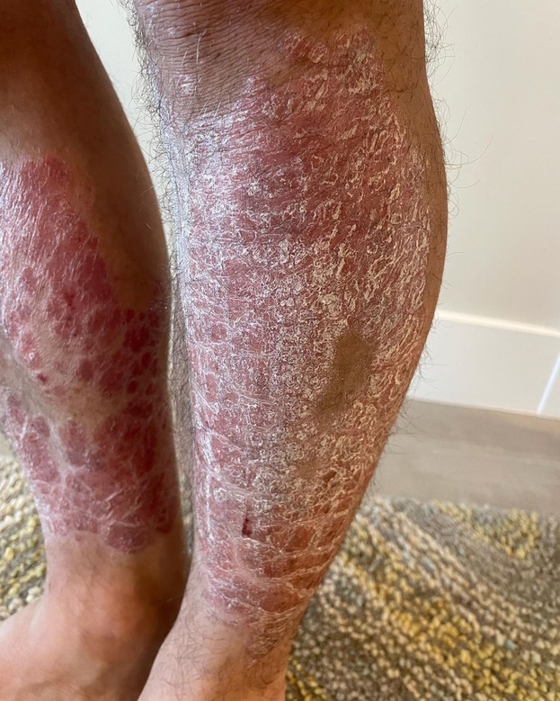 Ноги Мендеса до начала плотоядной диеты.