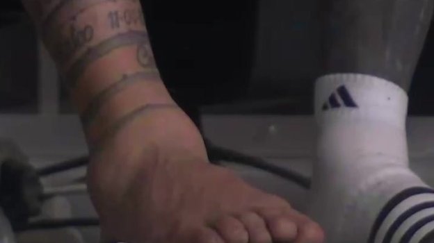 Опухшая нога Лионеля Месси.