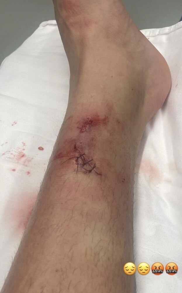 Травмированная нога Виллиана Роши.