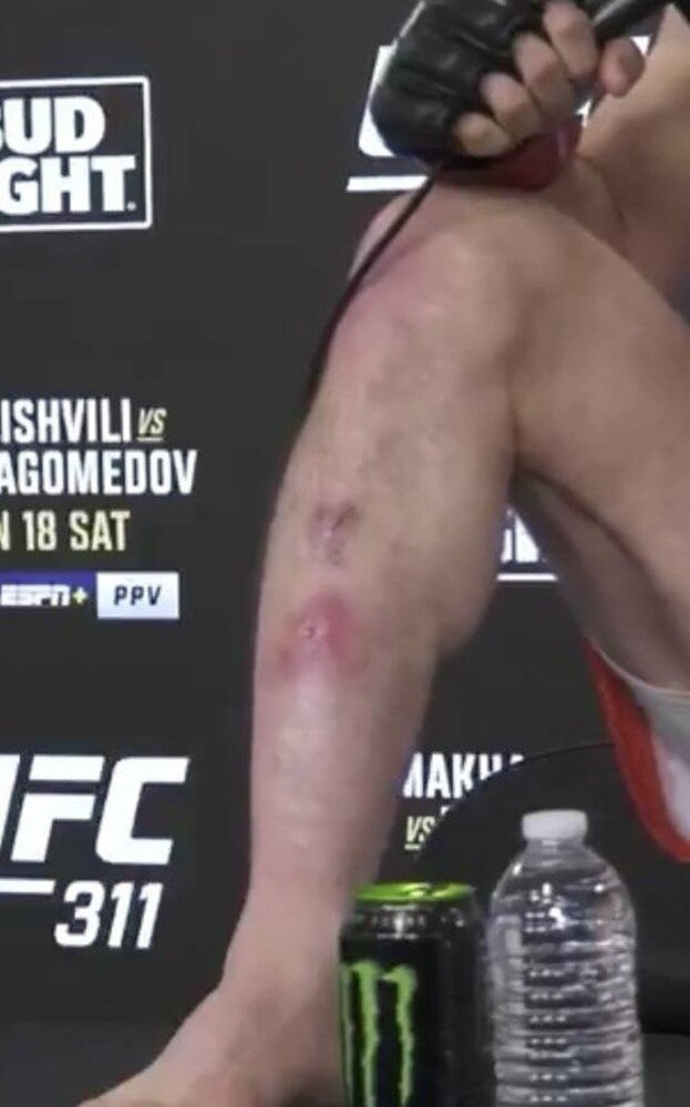 Двалишвили показал травмы на ноге, полученные до поединка с Нурмагомедовым.