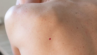 Красные родинки.