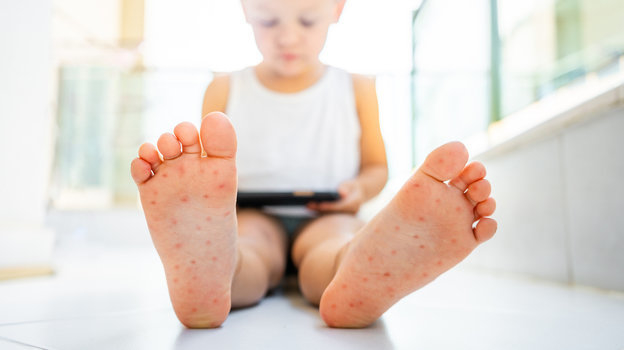 Мальчик болеет вирусом Коксаки