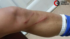 Нога Кристиана Нобоа после фола Дениса Глушаков.